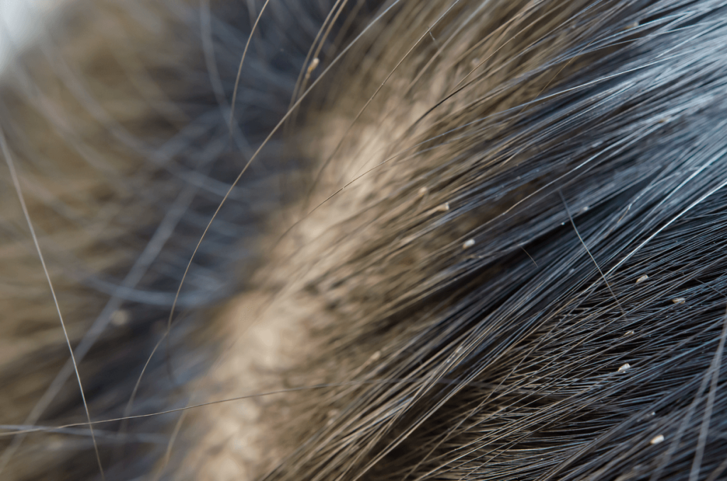 How To Get Rid Of Head Lice Naturally
