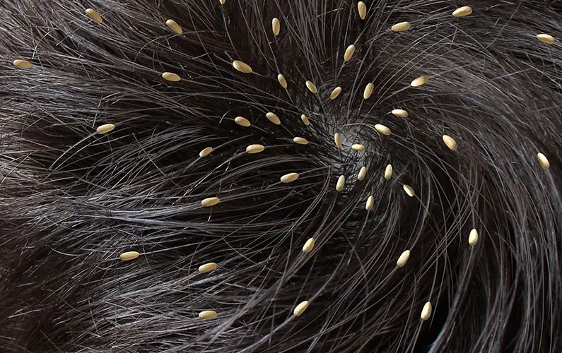 difference between lice eggs and dandruff